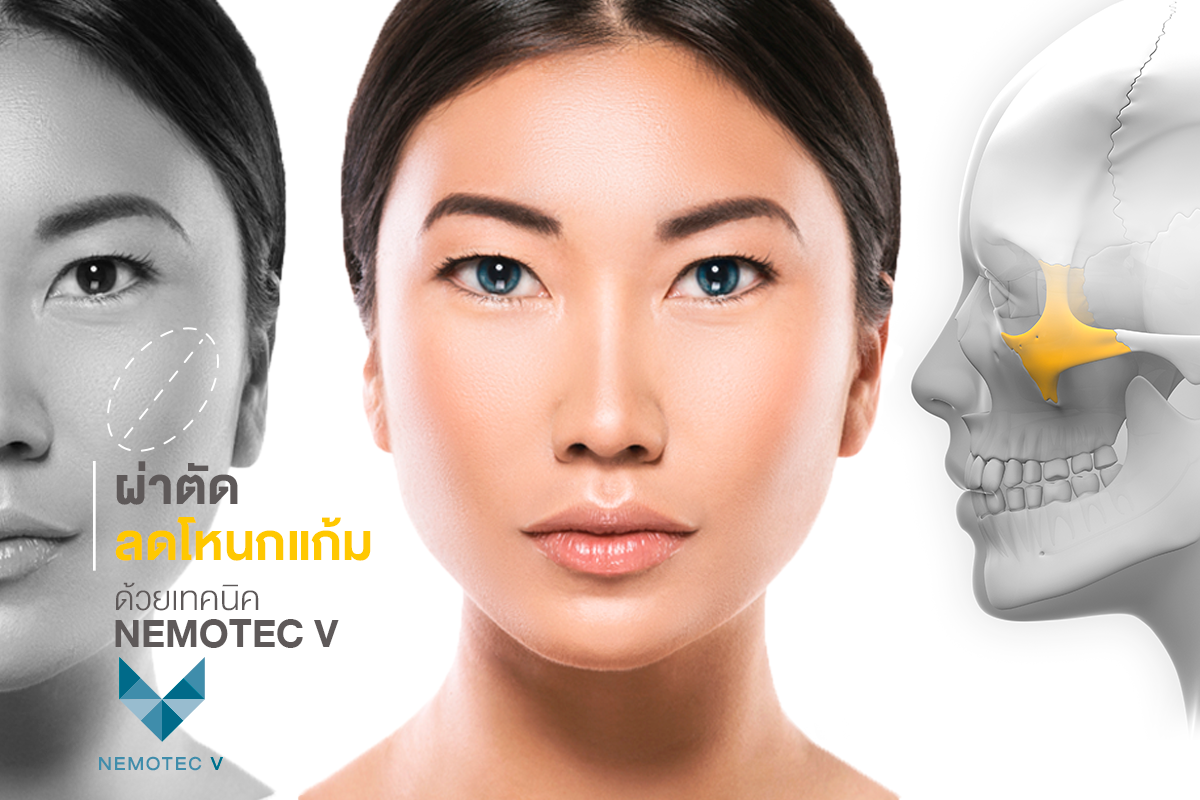 ผ่าตัดโหนกแก้ม