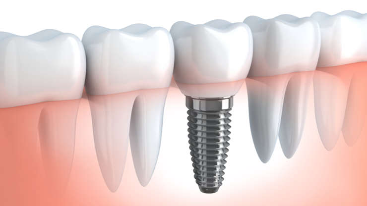 ทันตกรรมรากฟันเทียมระบบ Zygomatic Implant