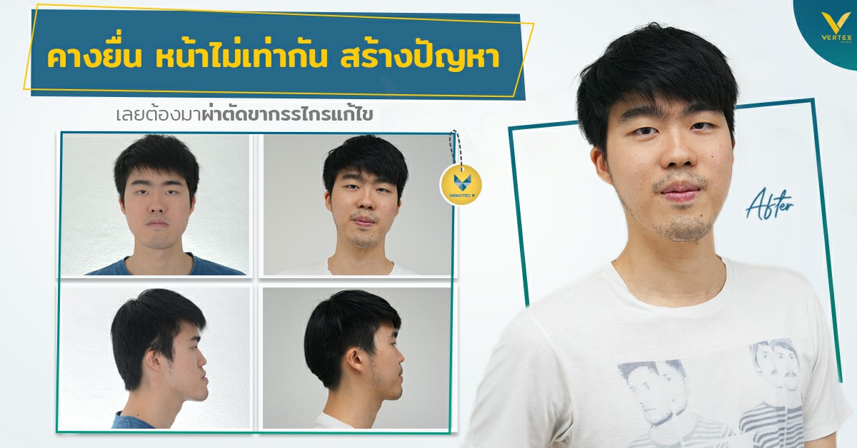 [รีวิวผ่าขากรรไกร] คางยื่น ฟันไม่สบกัน หน้าไม่เท่ากัน เลยต้องผ่าขากรรไกรแก้ไข