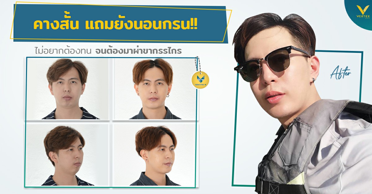 [รีวิวผ่าขากรรไกร] คางสั้น แถมยังนอนกรน ไม่อยากทน เลยต้องมาผ่าขากรรไกร