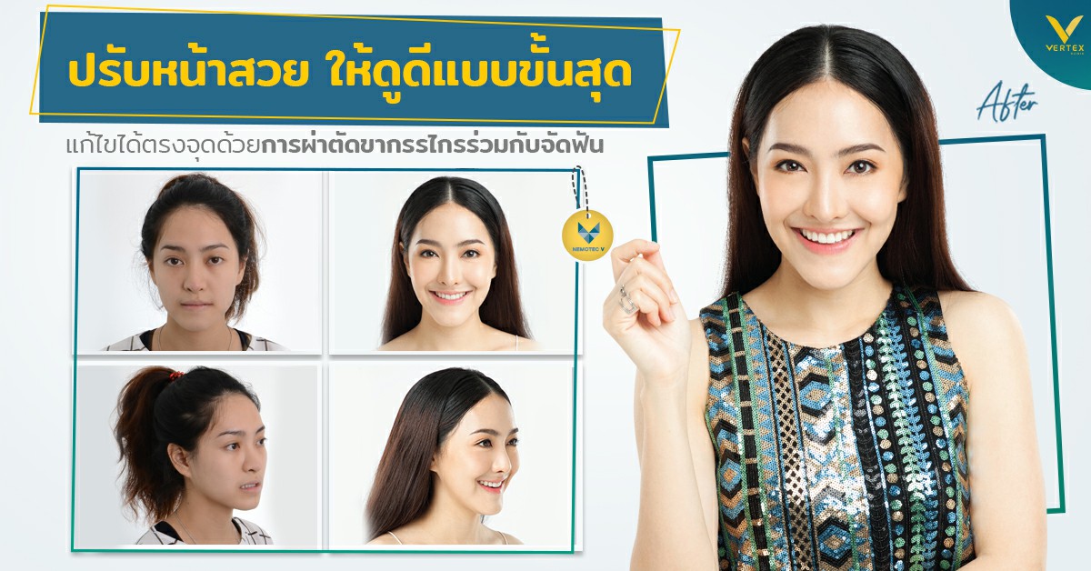 [รีวิวผ่าขากรรไกร] ปรับใบหน้าให้สวยกว่าเดิม ด้วยการผ่าขากรรไกรร่วมกับจัดฟัน