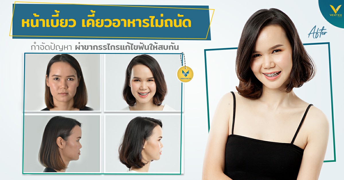 [รีวิวผ่าขากรรไกร] หน้าเบี้ยว ฟันไม่สบ เคี้ยวอาหารไม่ถนัด ผ่าขากรรไกร กำจัดปัญหา