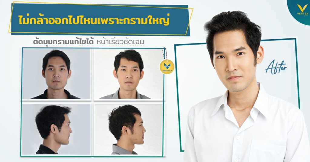 [รีวิวตัดกราม] กรามใหญ่ จนไม่กล้าออกไปไหน ผ่าตัดมุมกรามแก้ได้ หน้าเรียวชัดเจน
