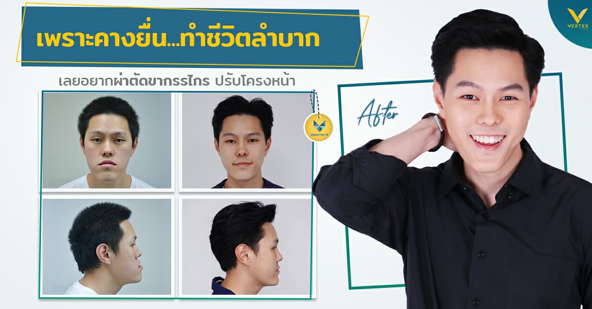 [รีวิวผ่าขากรรไกร] คางยื่น ทำชีวิตลำบาก เลยอยากผ่าตัดขากรรไกร ปรับโครงหน้า