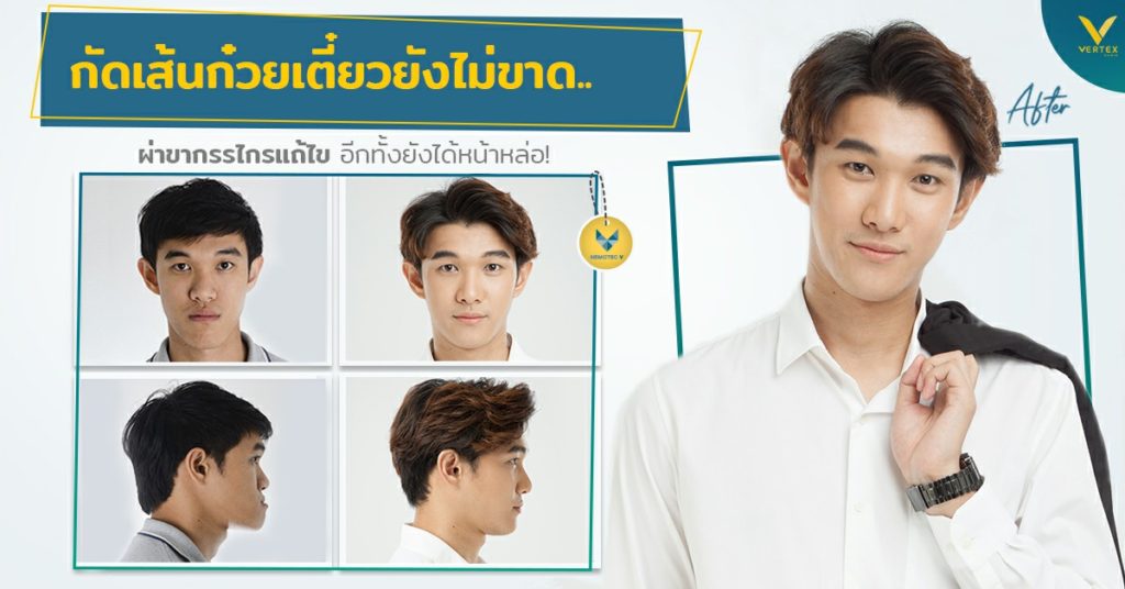 [รีวิวผ่าขากรรไกร] ฟันไม่สบ คางยื่น กัดเส้นก๋วยเตี๋ยวยังไม่ขาด ผ่าขากรรไกรแก้ไขได้