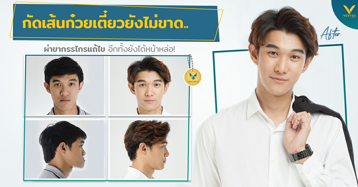 [รีวิวผ่าขากรรไกร] ฟันไม่สบ คางยื่น กัดเส้นก๋วยเตี๋ยวยังไม่ขาด ผ่าขากรรไกรแก้ไขได้