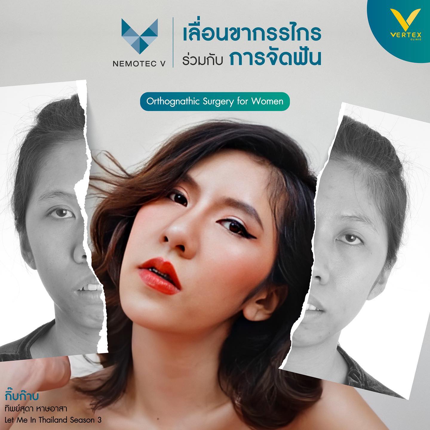 ศัลยกรรมปรับโครงหน้า ปรับให้ใบหน้ามีความสวยงามแบบไร้ที่ติทั่วทั้งหน้า