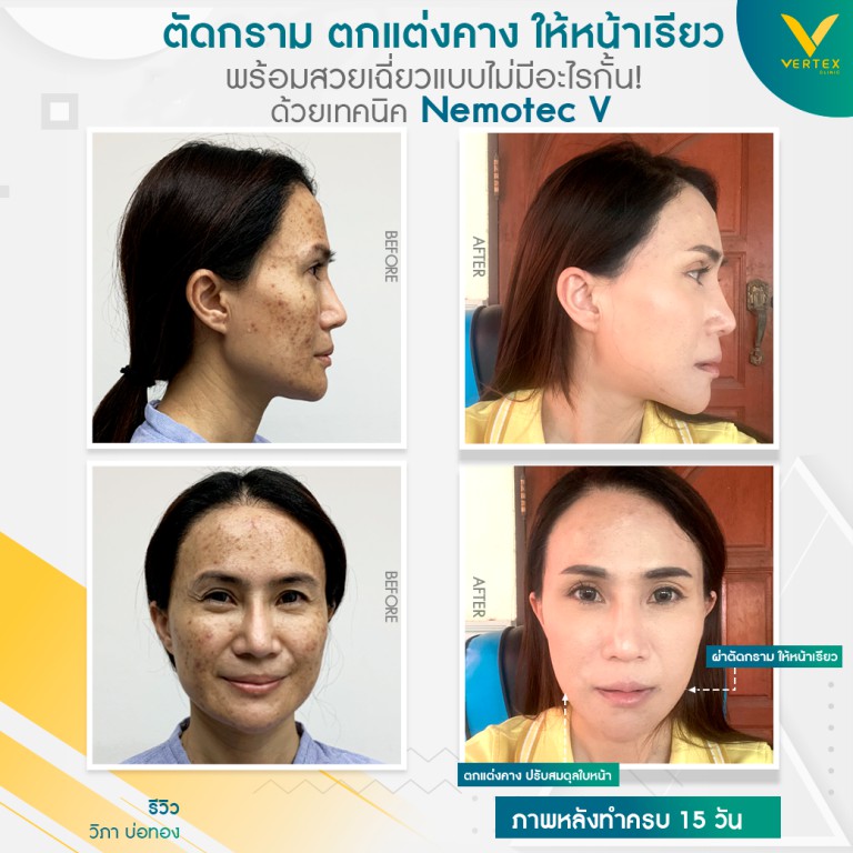 ปรับโครงหน้า ผ่าตัดมุมกราม และเสริมคาง โดยคนไข้จริง