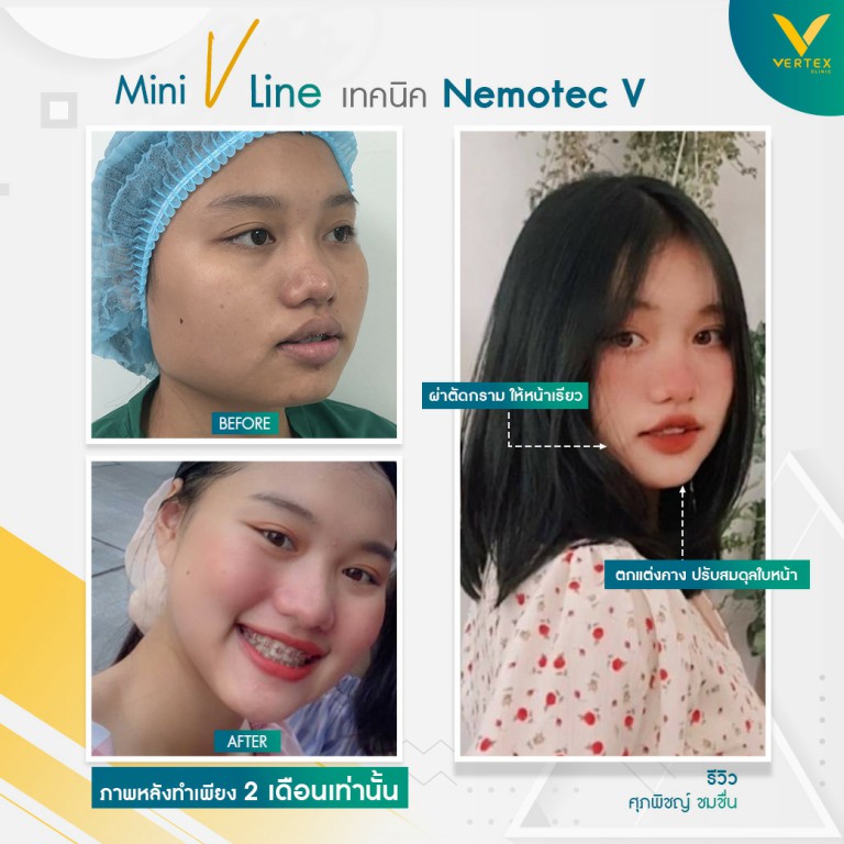 ปรับโครงหน้า ผ่าตัดมุมกราม และเสริมคาง โดยคนไข้จริง คุณศุภพิชญ์