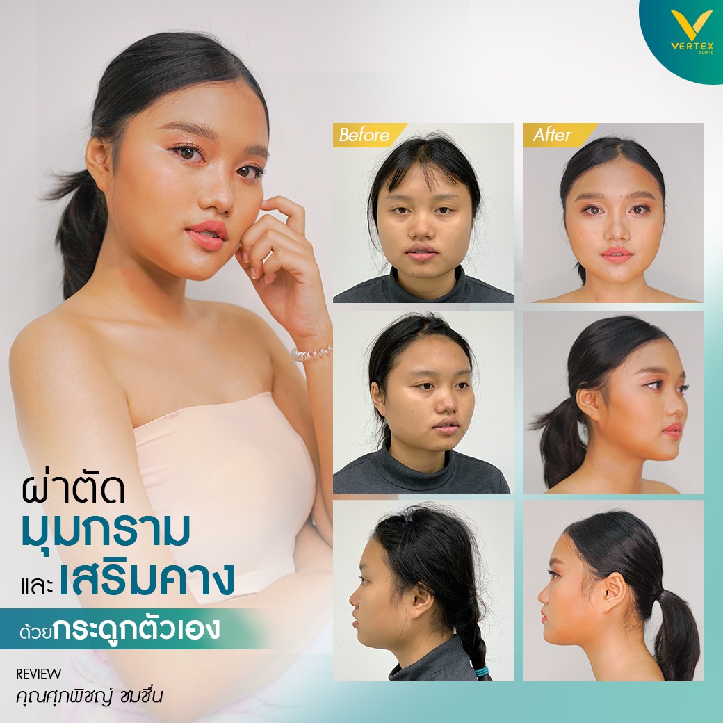 รีวิวผ่าตัดมุมกรามและคางจากคนไข้จริง คุณศภพิชญ์