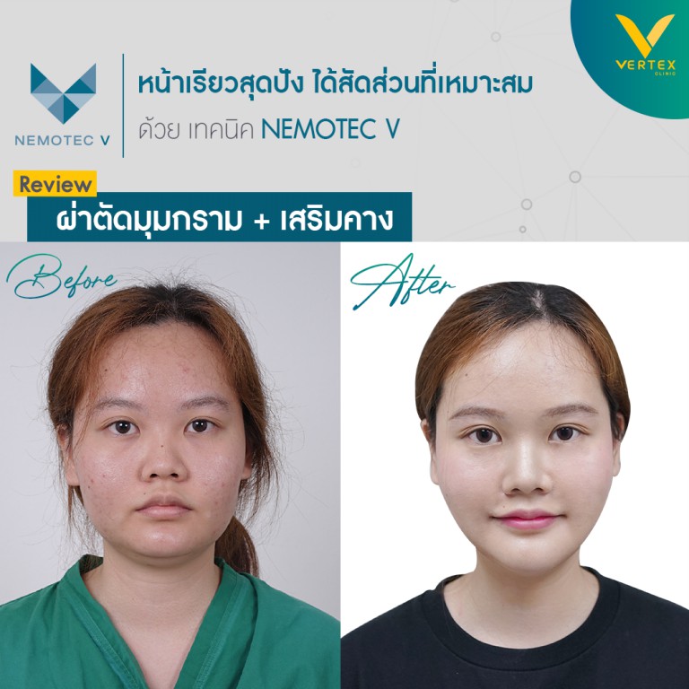 ตัดกราม ตกแต่งคางให้หน้าเรียวสวย รีวิวโดยคุณพุธิตา