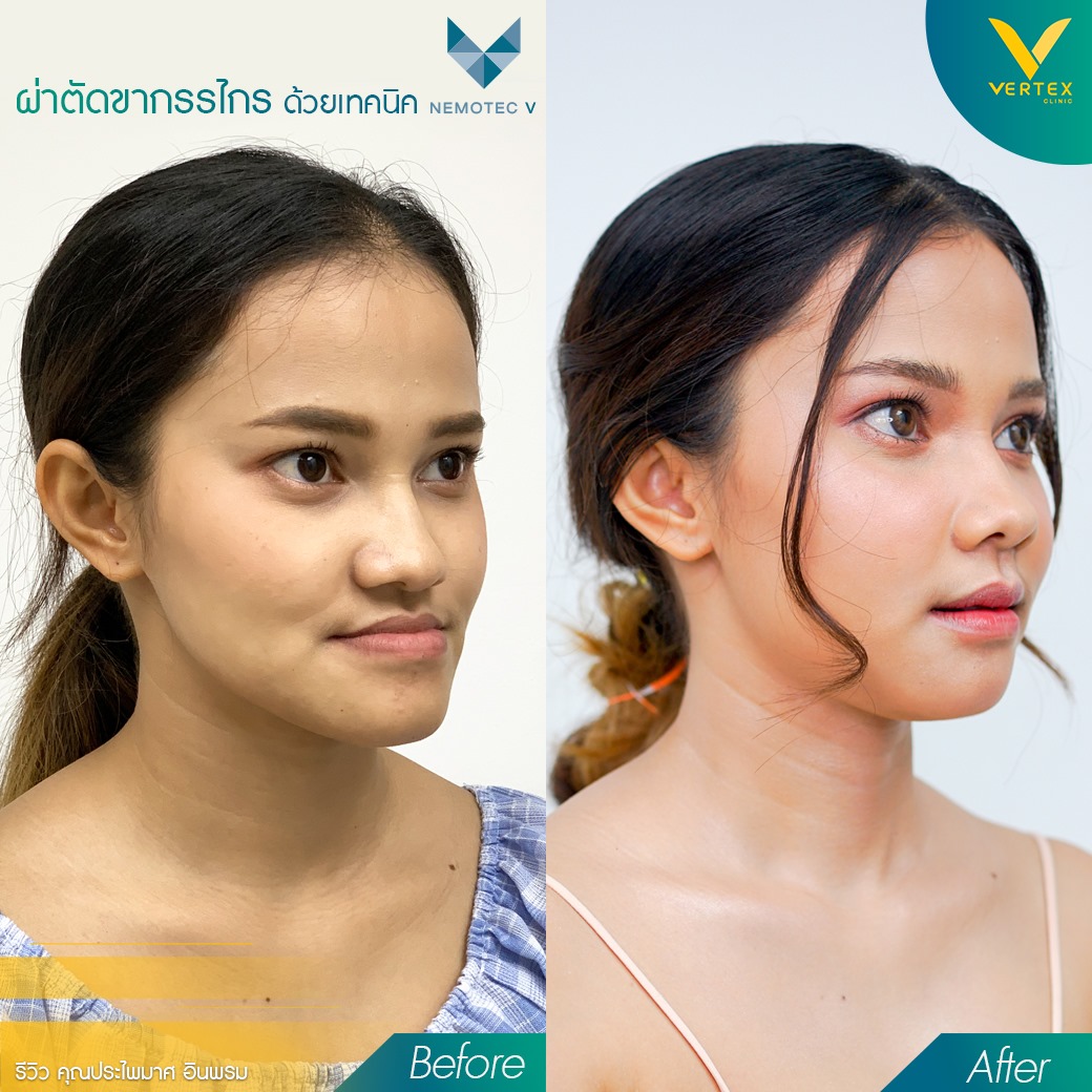 ผ่าตัดแก้ไขปัญหาคางยื่น ฟันไม่สบกัน จากคนไข้จริง คุณประไพมาศ