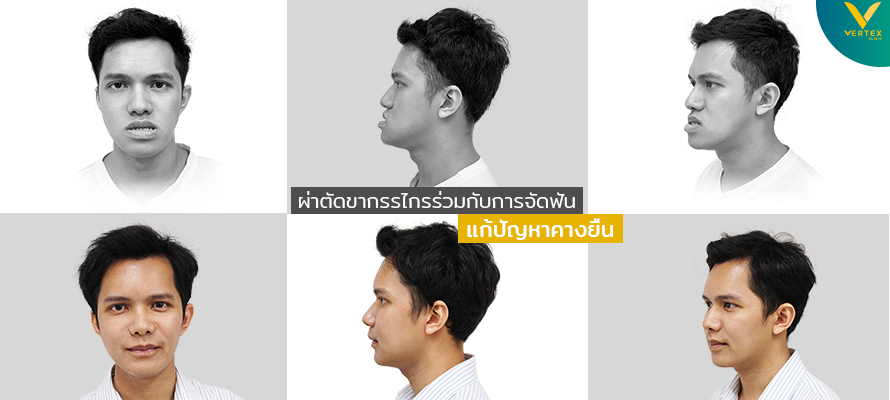 เปรียบเทียบการผ่าตัดแก้ไขคางโดยผ่าขากรรไกร เพื่อแก้ไขปัญหาคางยื่น หน้ายื่น จากคุณอธิวัฒน์