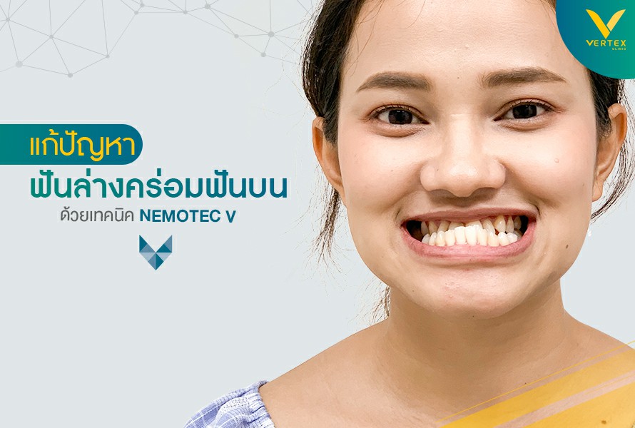 แก้ไขฟันล่างครอบฟันบน