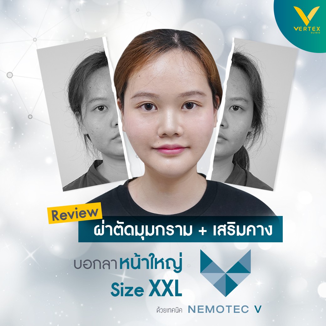 ตัดมุมกรามร่วมกับการเสริมคาง สร้างหน้าเรียวสวยแบบถาวร