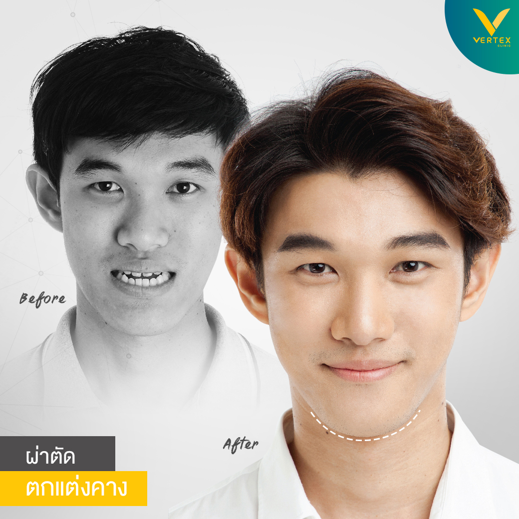 รีวิวเสริมคางด้วยกระดูกตัวเองจากลูกค้าจริง คุณแทนพงษ์