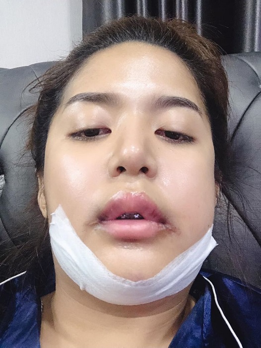 กลับบ้านวันแรก ขยับใบหน้าลำบาก กินข้าวไม่ได้