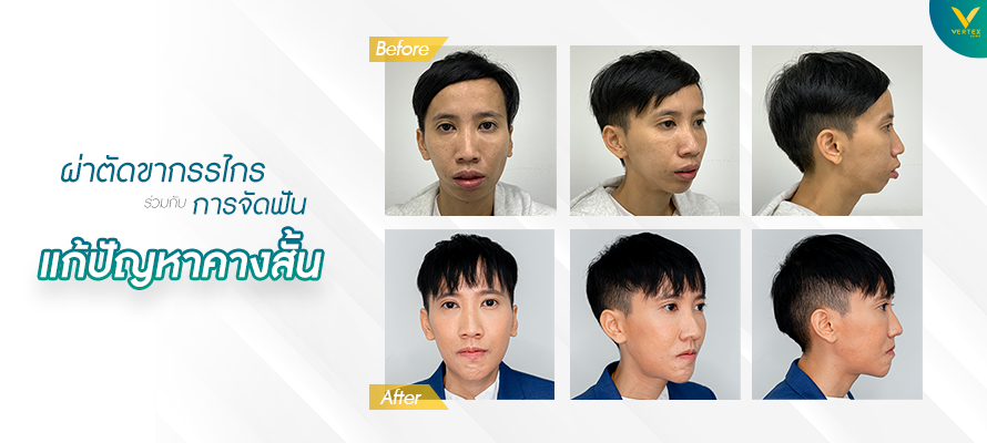 ผ่าตัดขากรรไกร แก้ไขคางสั้น โดยคุณจิรวรรณ