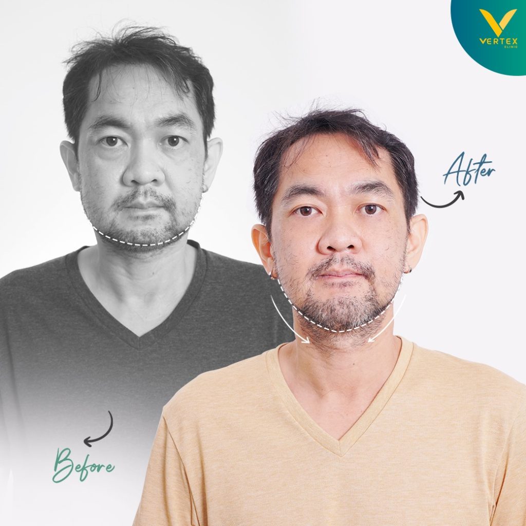 ผ่าตัดขากรรไกร แก้ไขคางสั้น โดยลูกค้าจริงของ Vertex มุมตรง