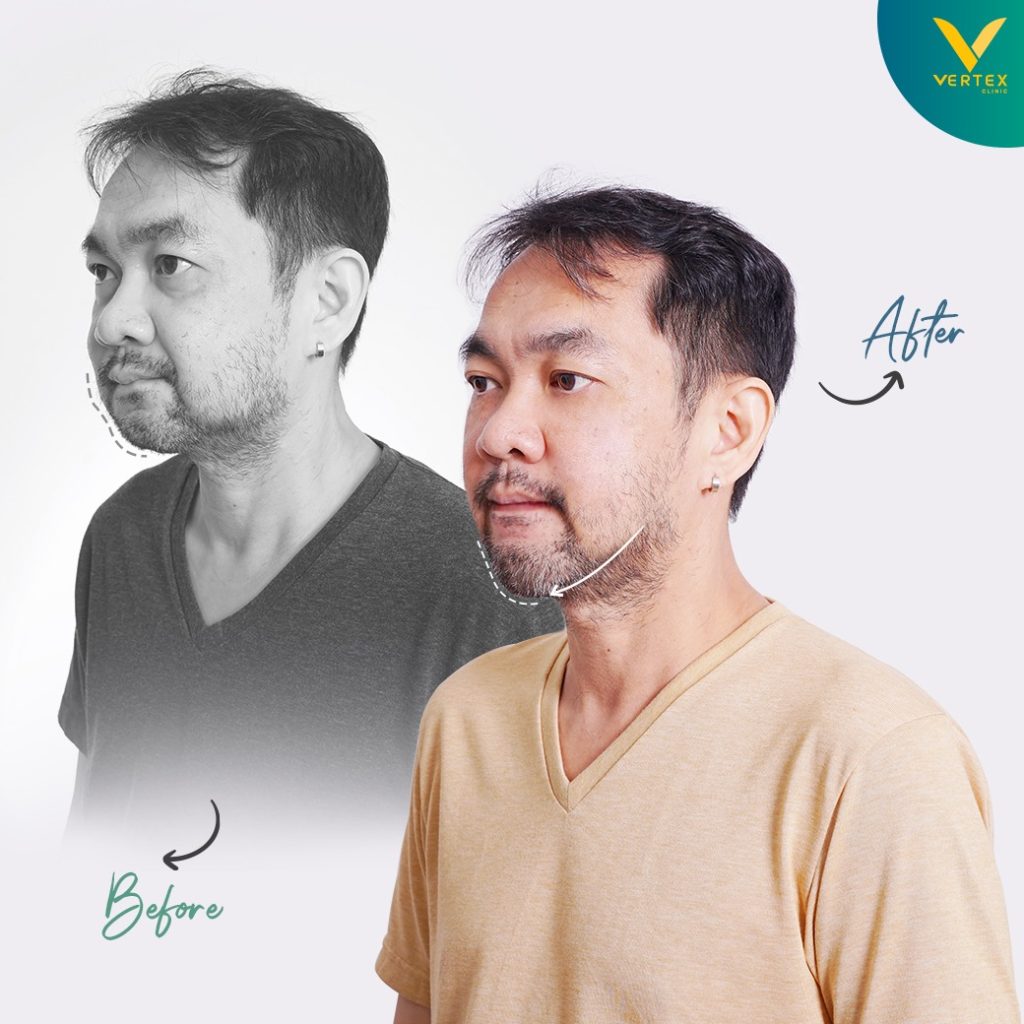 ผ่าตัดขากรรไกร แก้ไขคางสั้น โดยลูกค้าจริงของ Vertex มุม 45 องศา