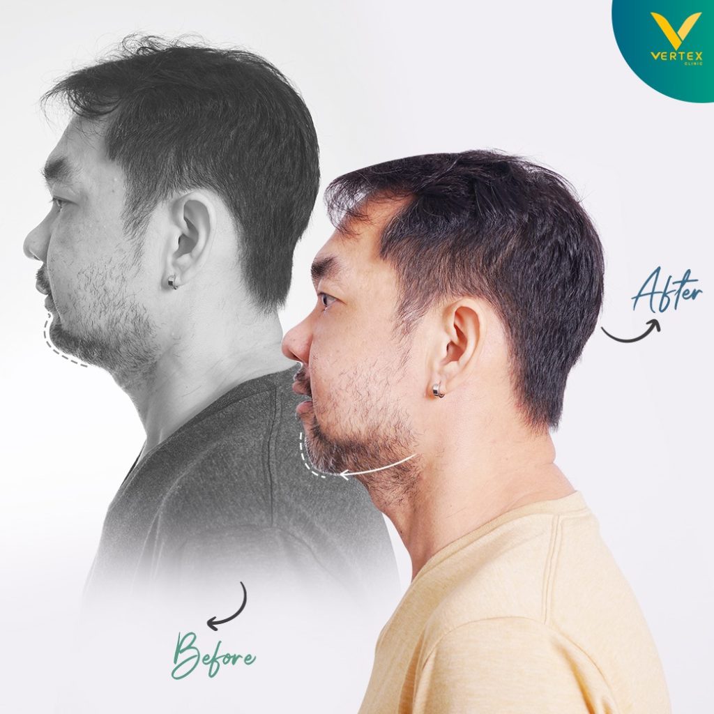 ผ่าตัดขากรรไกร แก้ไขคางสั้น โดยลูกค้าจริงของ Vertex มุมซ้าย