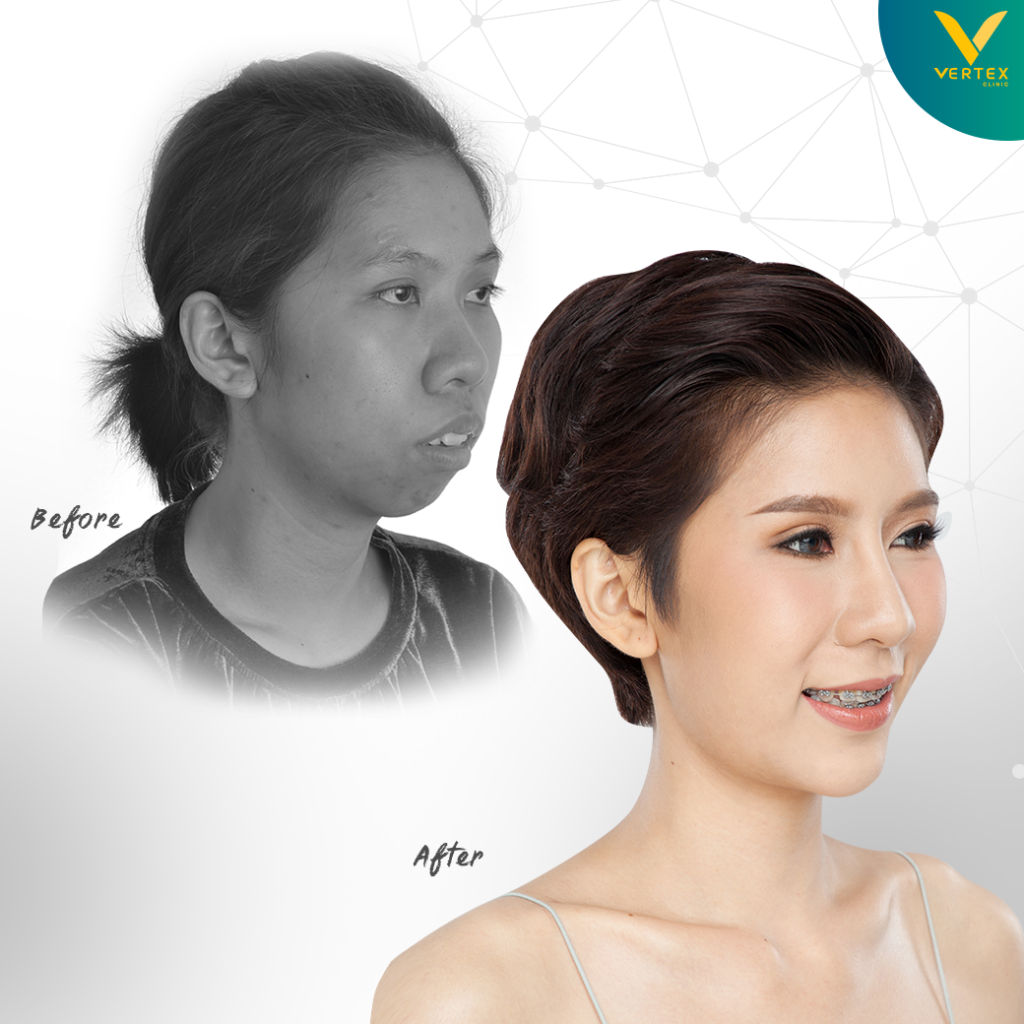 ผ่าตัดขากรรไกร แก้ไขคางสั้น โดยคุณกิ๊บก๊าบ มุมขวา