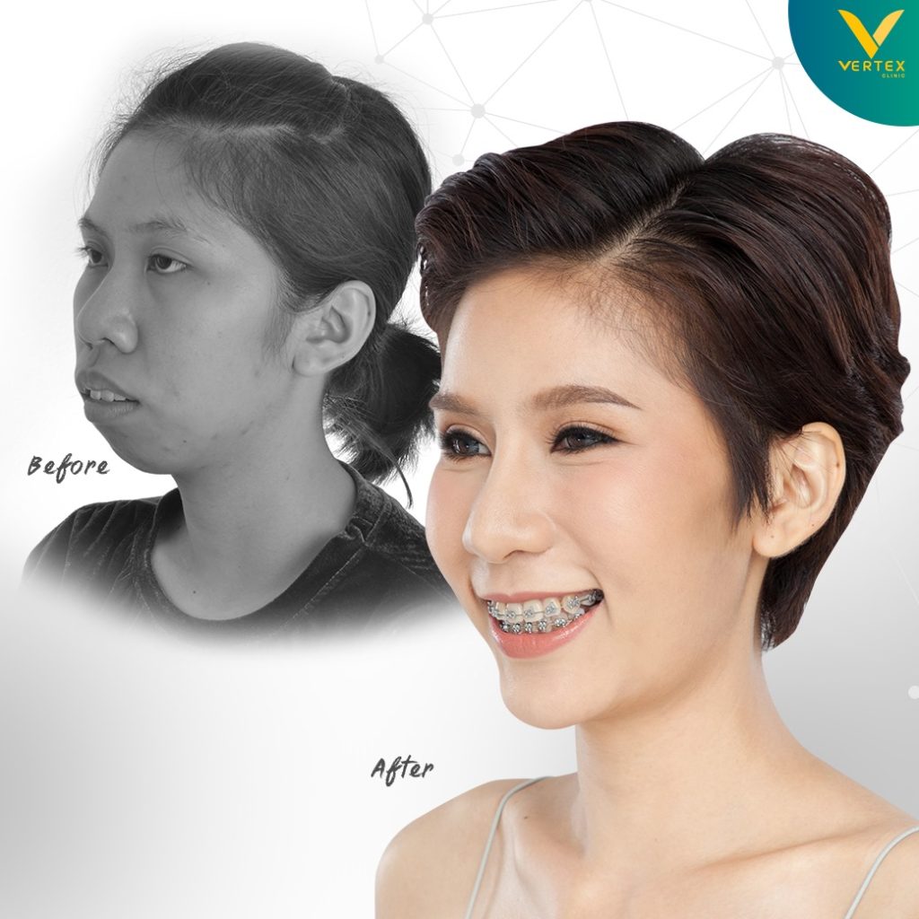 ผ่าตัดขากรรไกร แก้ไขคางสั้น โดยคุณกิ๊บก๊าบ มุมซ้าย