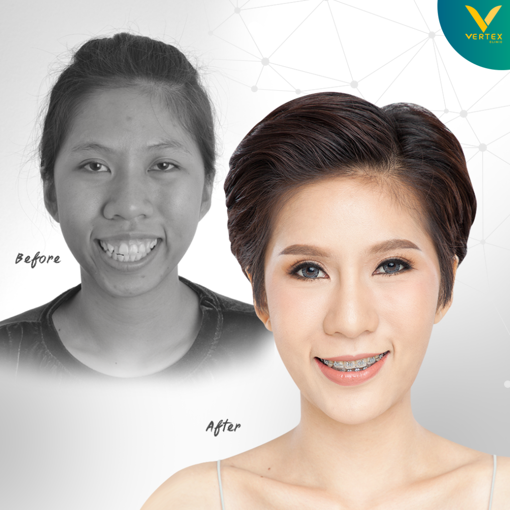 ผ่าตัดขากรรไกร แก้ไขคางสั้น โดยคุณกิ๊บก๊าบ มุมตรง