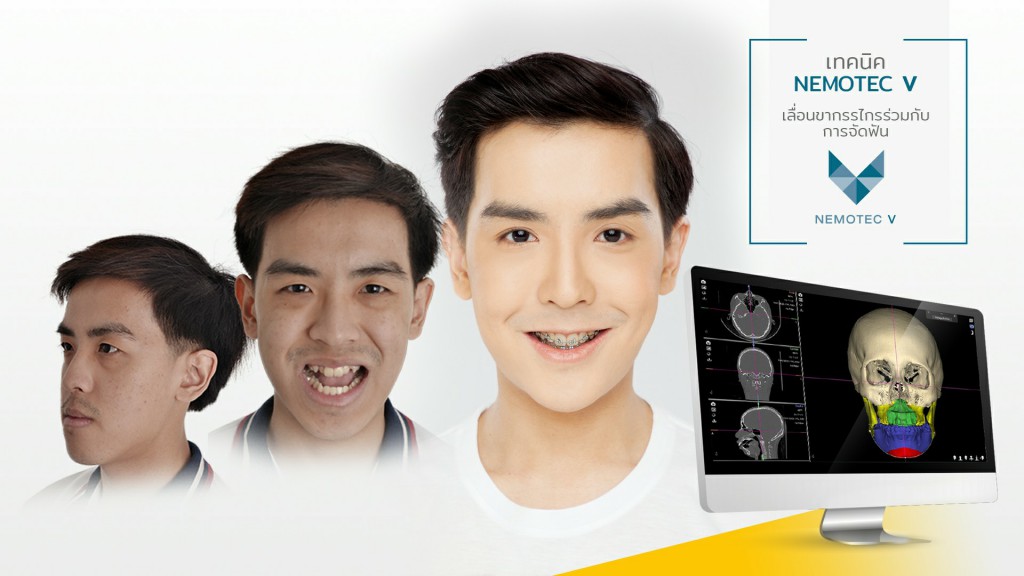รีวิวเทคนิค Nemotec v