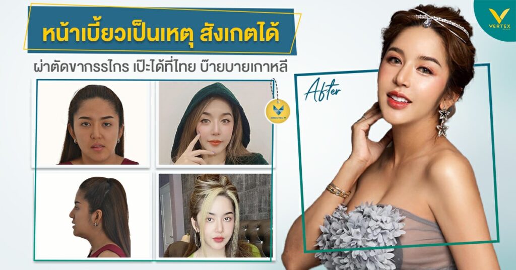 คุณนัส ผ่าขากรรไกร
