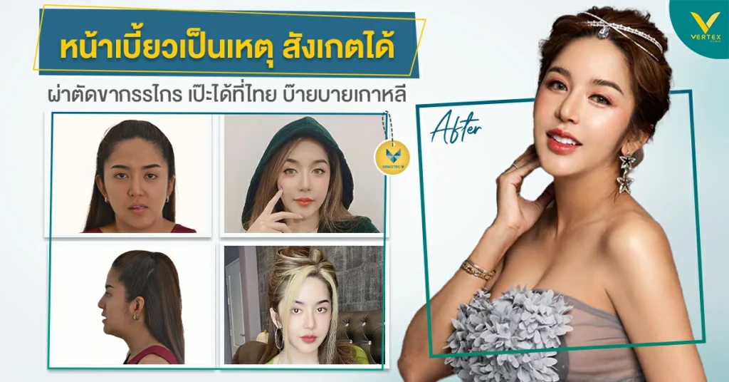 คุณนัส ผ่าขากรรไกร