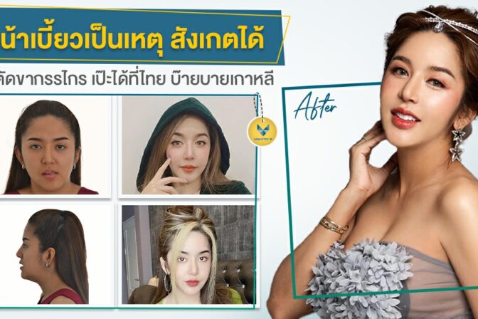[รีวิวผ่าขากรรไกร] หน้าเบี้ยวเป็นเหตุสังเกตได้