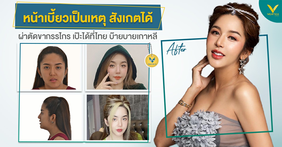 [รีวิวผ่าขากรรไกร] หน้าเบี้ยวเป็นเหตุสังเกตได้