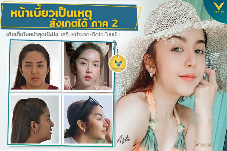 [รีวิวเสริมหน้าผาก+ดึงหน้า+ยกคิ้ว+ฉีดไขมัน] หน้าเบี้ยวเป็นเหตุสังเกตได้ภาค2