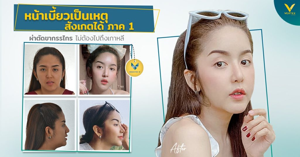 รีวิวเสริมหน้าผากดึงหน้ายกคิ้วฉีดไขมันหน้าเบี้ยวเป็นเหตุ