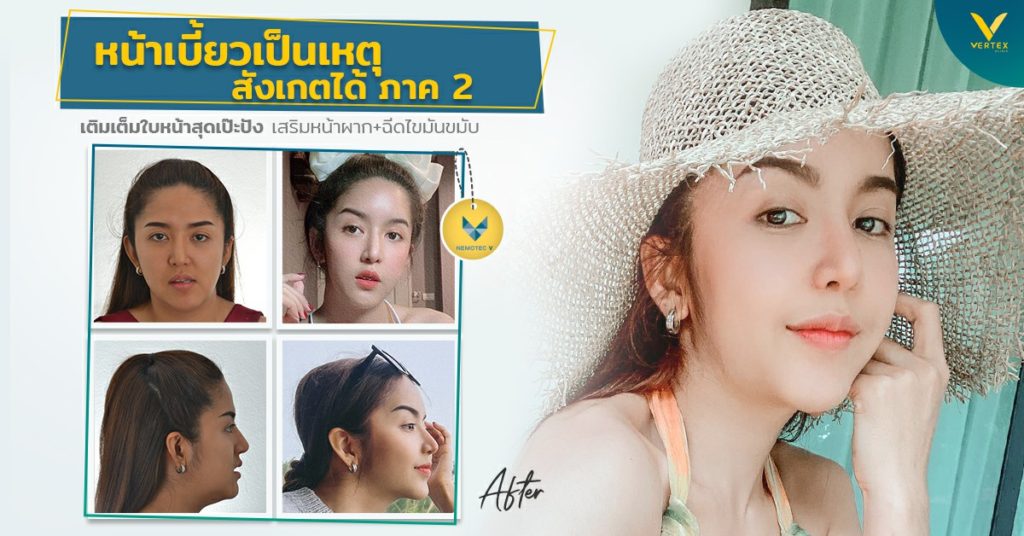 รีวิวเสริมหน้าผากดึงหน้ายกคิ้วฉีดไขมันหน้าเบี้ยวเป็นเหตุ-สังเกตได้