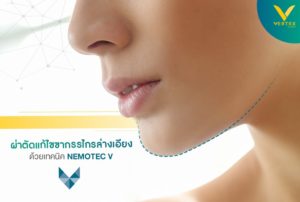 แก้ปัญหาขากรรไกรล่างเอียง ด้วย Nemotec V