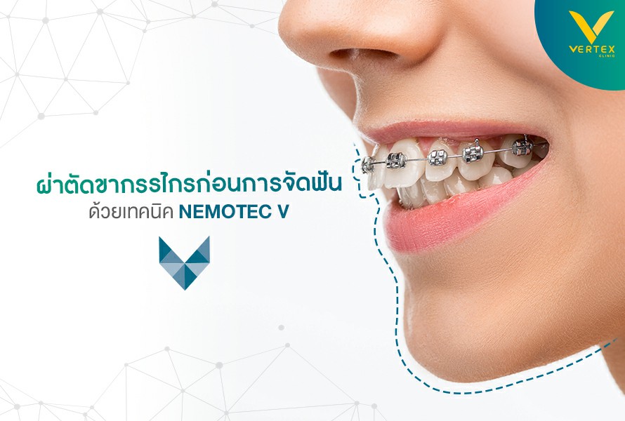ผ่าตัดขากรรไกรก่อนจัดฟัน เทคนิค Surgery First
