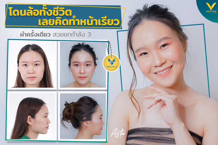 [รีวิวตัดกราม+ตัดไขมันกระพุ้งแก้ม+ทำคาง] โดนล้อทั้งชีวิตเลยคิดทำหน้าเรียว ผ่าครั้งเดียว สวยยกกำลังสาม