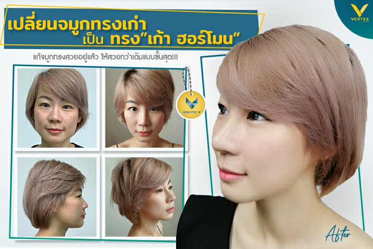 [รีวิวทำจมูก] แก้จมูกทรงเก่า เป็นทรง เก้า ฮอร์โมน