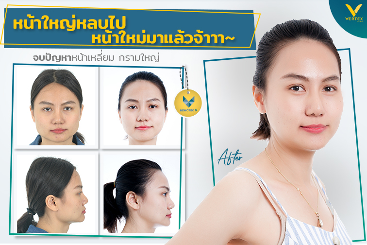 [รีวิวตัดกราม] หน้าใหญ่หลบไปหน้าใหม่มาแล้วตัดกรามแก้ปัญหาหน้าเหลี่ยม