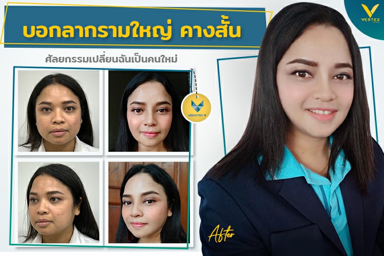 [รีวิวตัดกราม+ตัดไขมันกระพุ้งแก้ม+ทำคาง+ทำจมูก] บอกลาหน้าบานกรามใหญ่คางสั้นศัลยกรรมเปลี่ยนฉันเป็นคนใหม่
