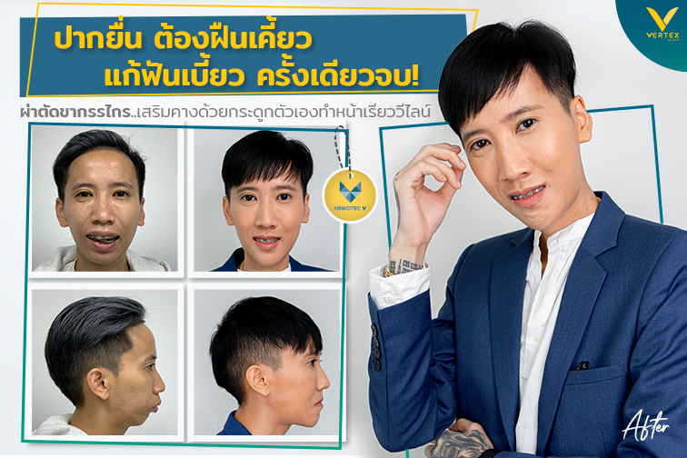 [รีวิวผ่าขากรรไกรร่วมกับจัดฟัน+ทำคาง] ปากอูมปากยื่น ต้องฝืนเคี้ยว เลื่อนขากรรไกร แก้ฟันเบี้ยว ครั้งเดียวจบ!