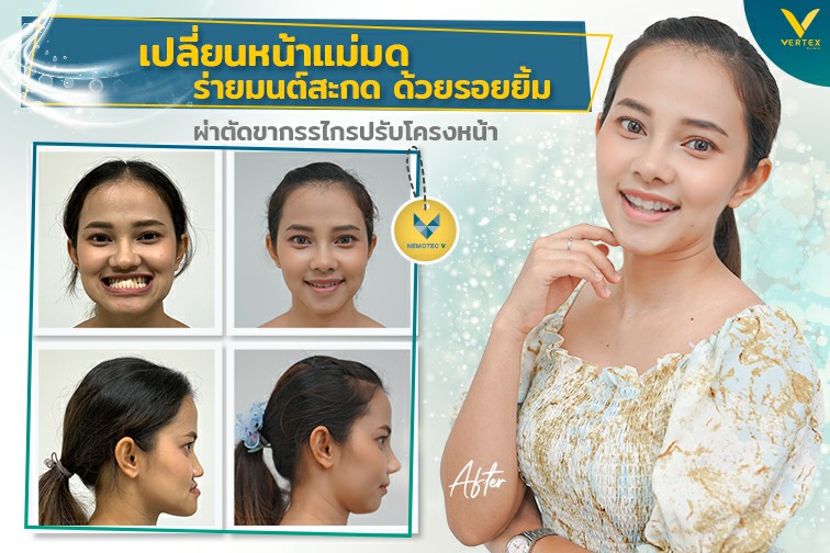 [รีวิวผ่าขากรรไกร] เปลี่ยนหน้าแม่มดร่ายมนต์สะกดด้วยรอยยิ้ม