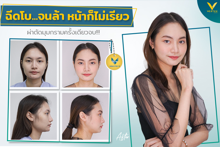 [รีวิวตัดกราม] ฉีดโบ..จนล้าหน้าก็ไม่เรียวผ่าตัดมุมกรามครั้งเดียวจบ!!!