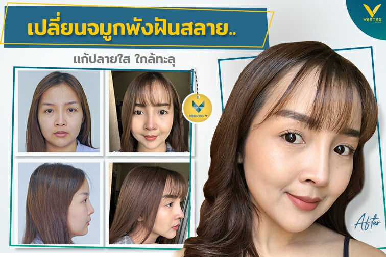 [รีวิวทำจมูก] จมูกปลายใสจนใกล้ทะลุ!ต้องรีบมาแก้จมูก