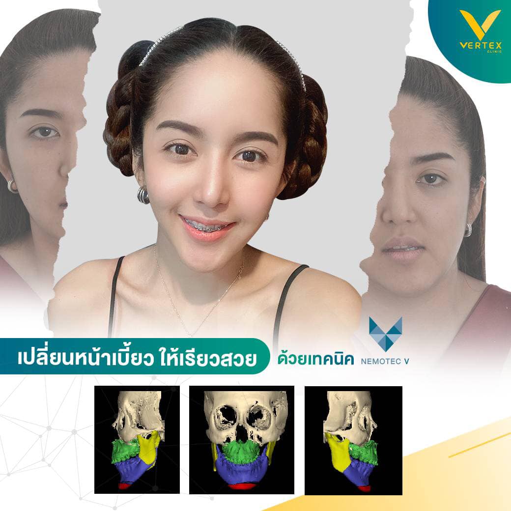 แก้ไขปัญหาใบหน้าไม่เท่ากัน หน้าเบี้ยว รีวิวจากคุณจุฑารัตน์
