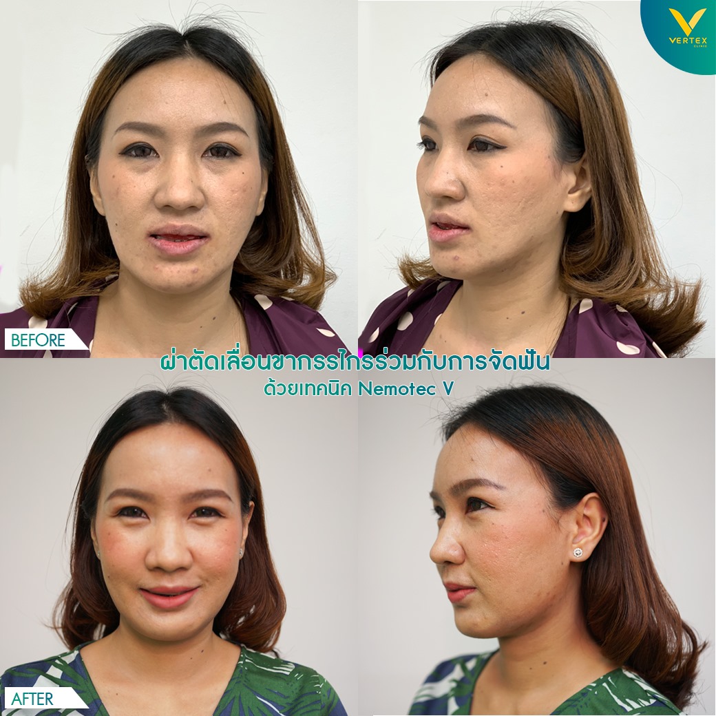 แก้ไขปัญหาใบหน้าไม่เท่ากัน หน้าเบี้ยว รีวิวจากคนไข้จริง