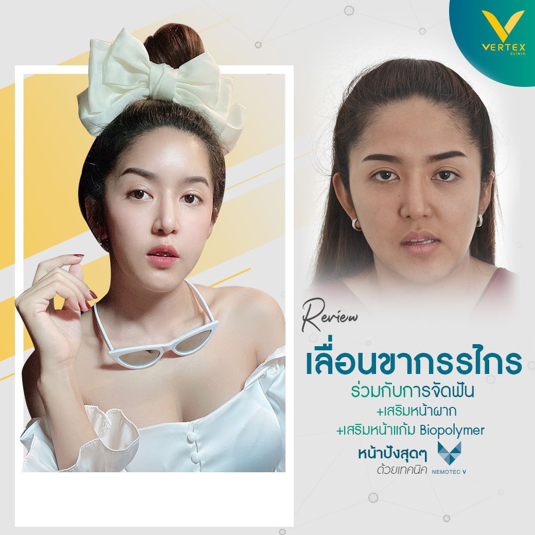 ภาพก่อนและหลัง ทำการแก้ไขอาการขากรรไกรล่างเอียง คุณจุฑารัตน์