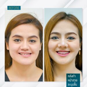 ภาพก่อนและหลัง ทำการแก้ไขอาการขากรรไกรล่างเอียง คุณศรัญญา